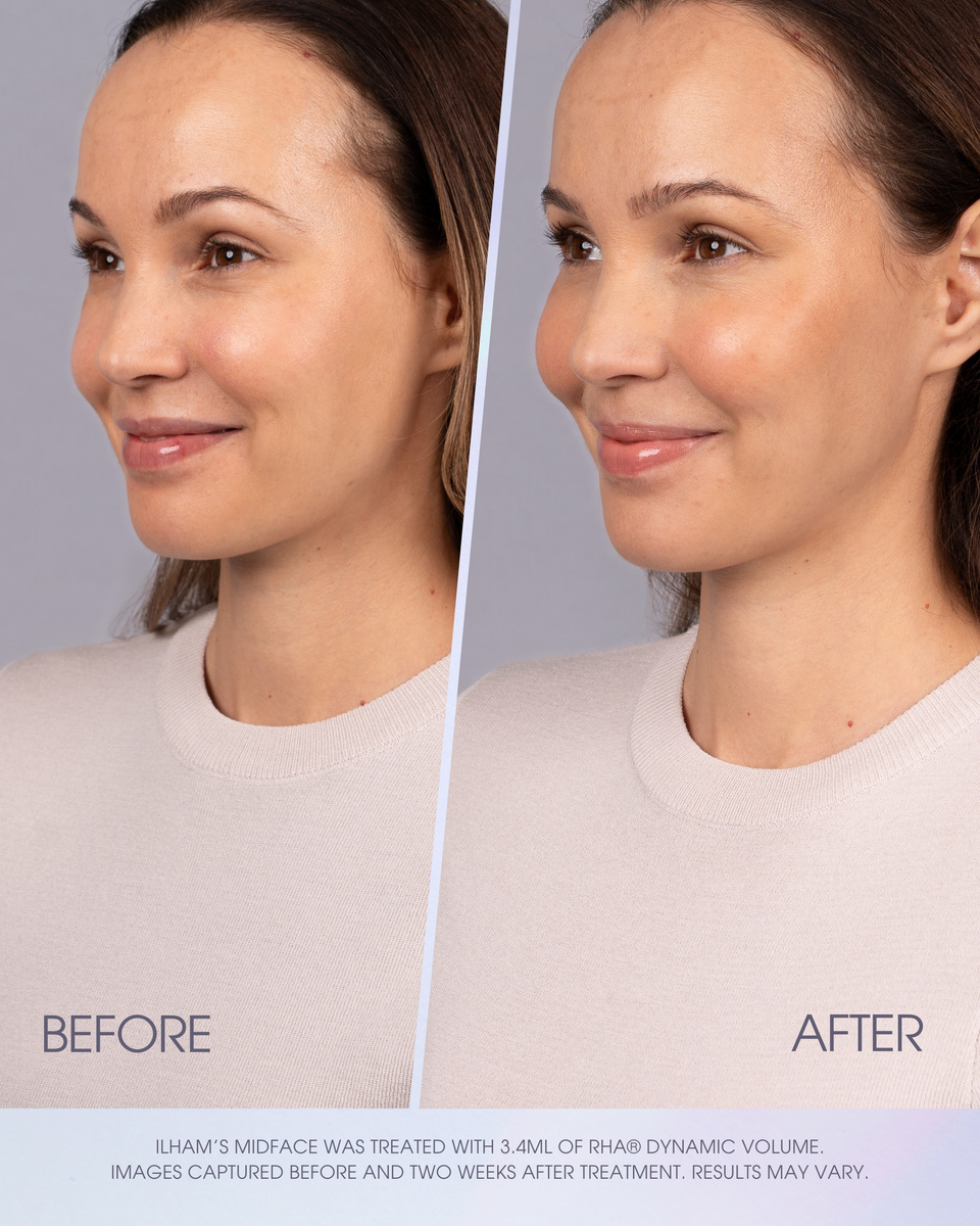 Teoxane RHA® Collection - Dynamic Volume Coming Soon Social Toolkit - Option 1 Slide 2 of 5.jpg