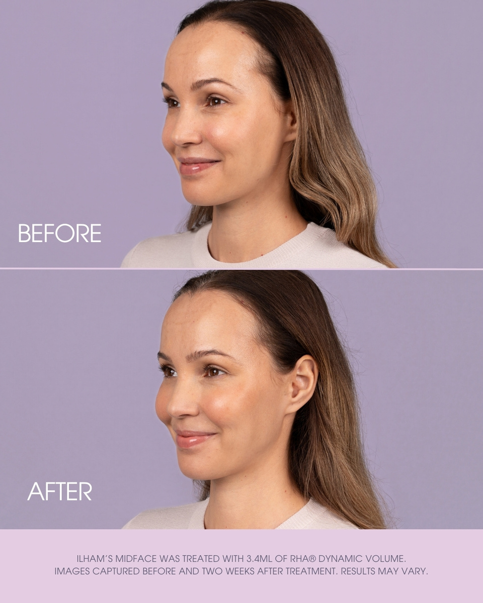 Teoxane RHA® Collection - Dynamic Volume Launch Social Toolkit - Option 2 Slide 4 of 6.jpg