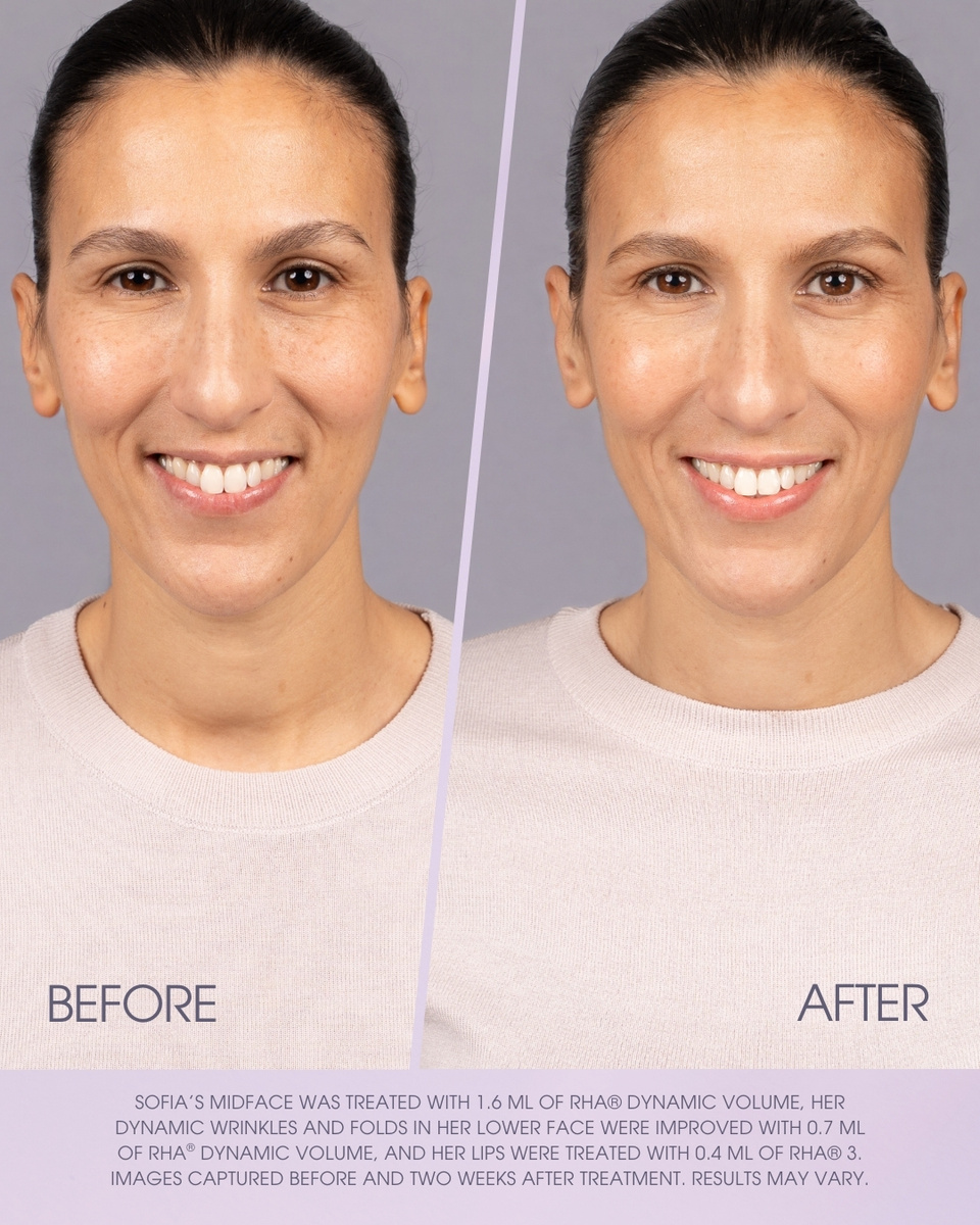 Teoxane RHA® Collection - Dynamic Volume Launch Social Toolkit - Option 3 Slide 3 of 5.jpg