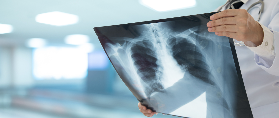 foto_blog_pneumonia.webp
