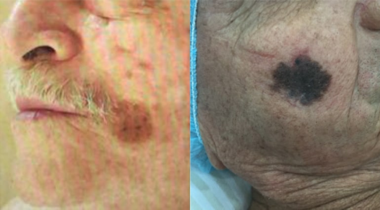 melanoma em idosos