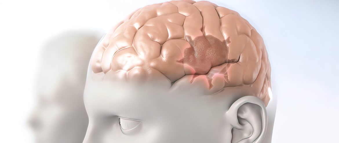 tumores-cerebrais-min.jpg