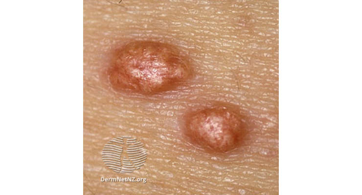 xanthoma-wide-crop .png