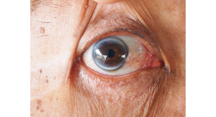 eye-arcus-senilis-wide-crop.png