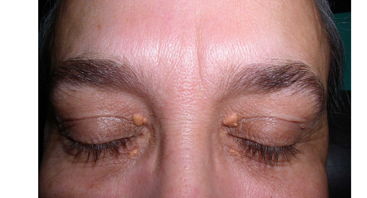 xanthelasma-wide-crop .png