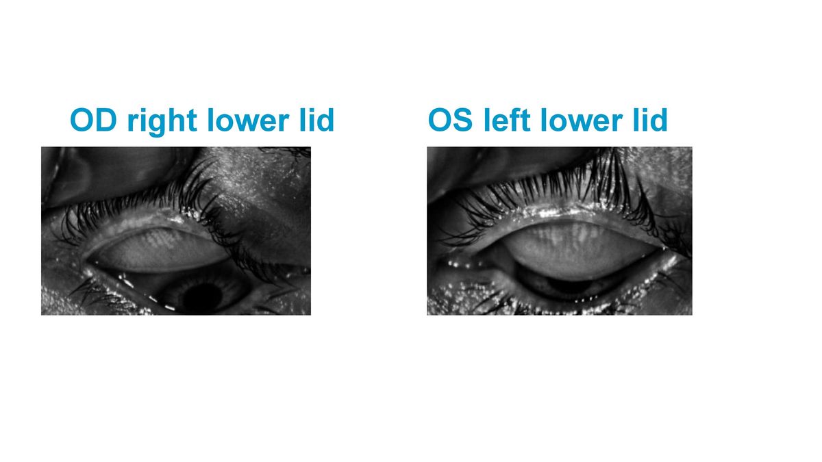 How to Treat Dry Eye Disease 2021.04.18 S.L.Cremers-page-013.jpg